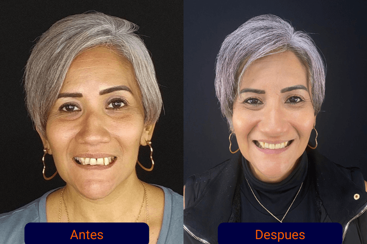 antes y después de nilda llados