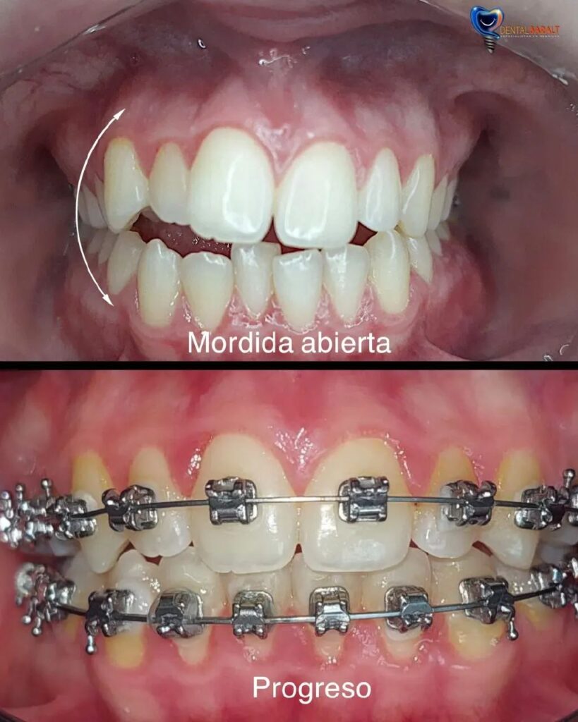 dientes rectos, tiempo rápido Mordida abierta y progreso