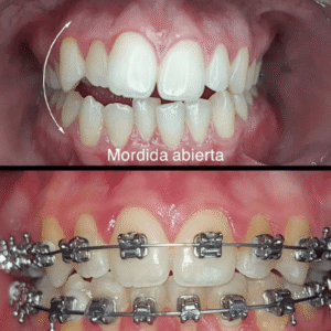 dientes rectos, tiempo rápido