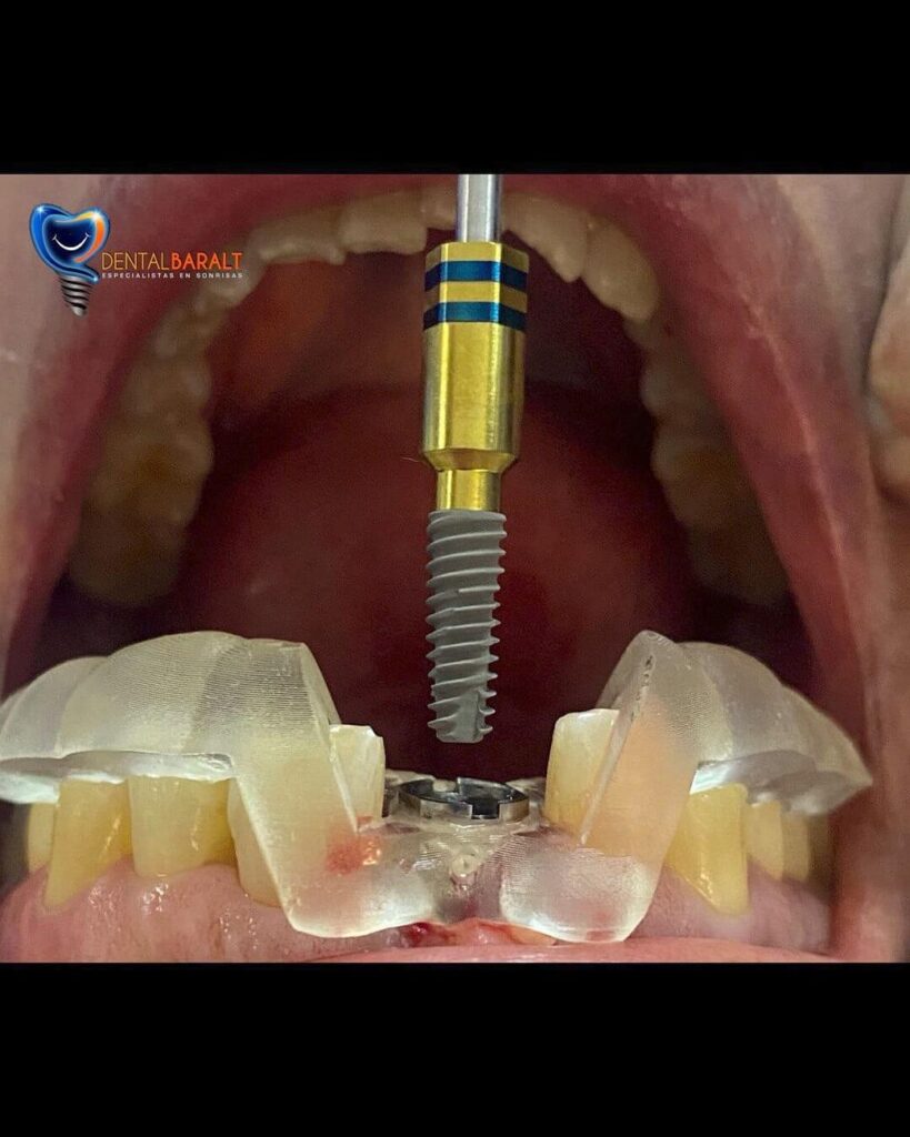 estás buscando una solución permanente y natural para reemplazar dientes perdidos