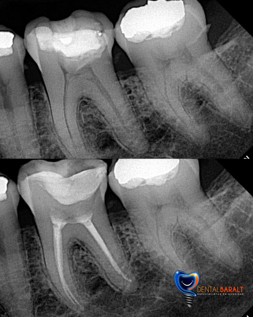 Endodoncia