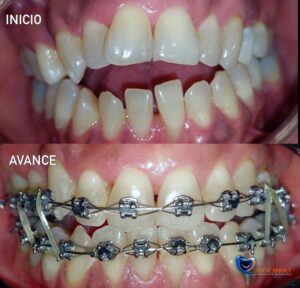 ortodoncia avances