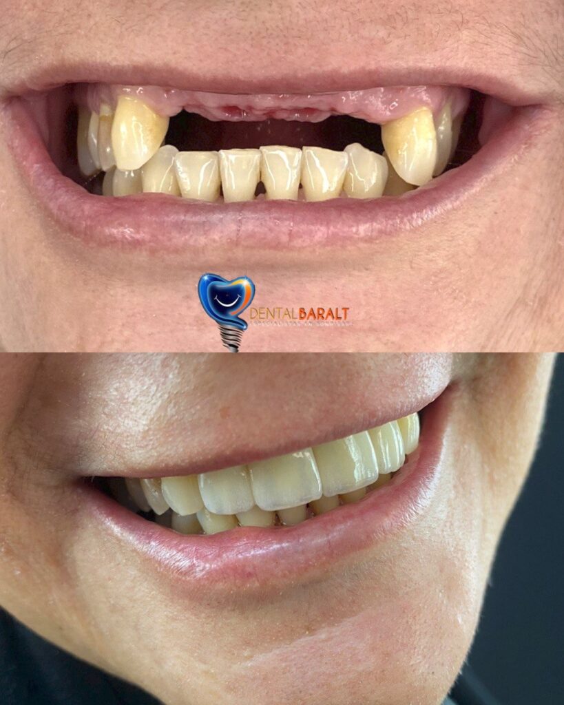 La Verdad sobre los Implantes Dentales