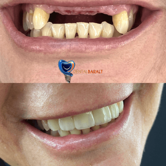 la verdad sobre los implantes dentales