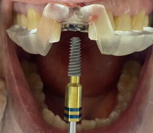 foto portada para la carpeta de implantes