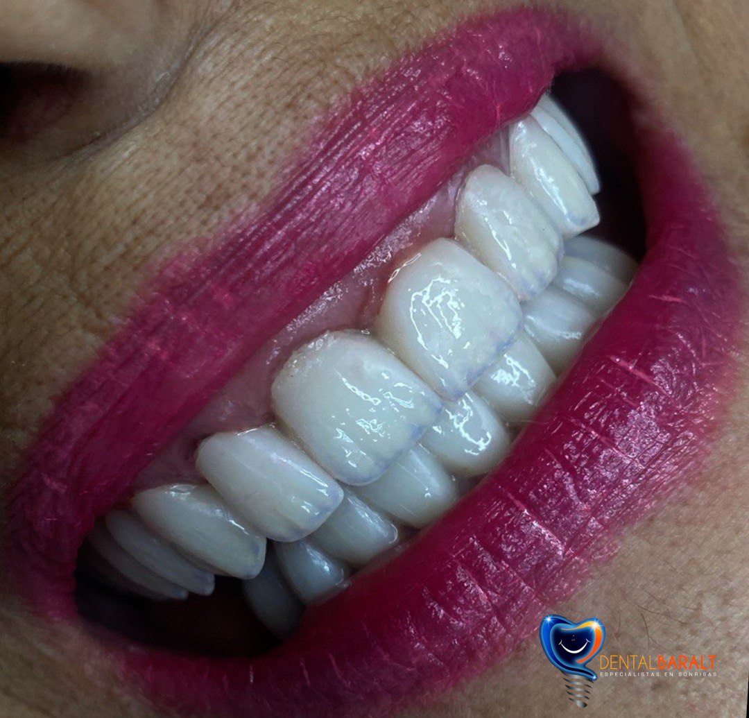 Prótesis dental carrillas