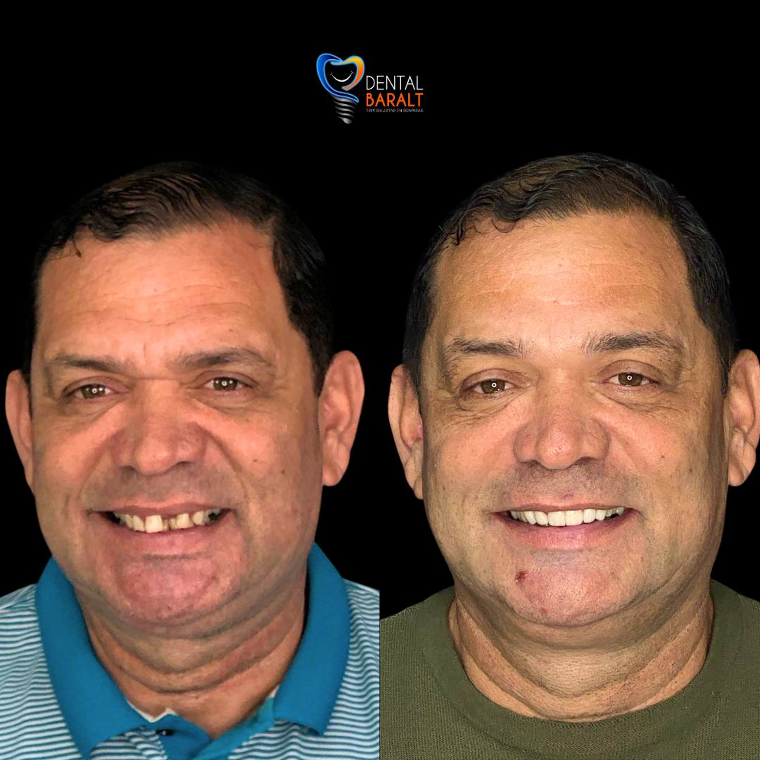 Antes y después coronas dentales