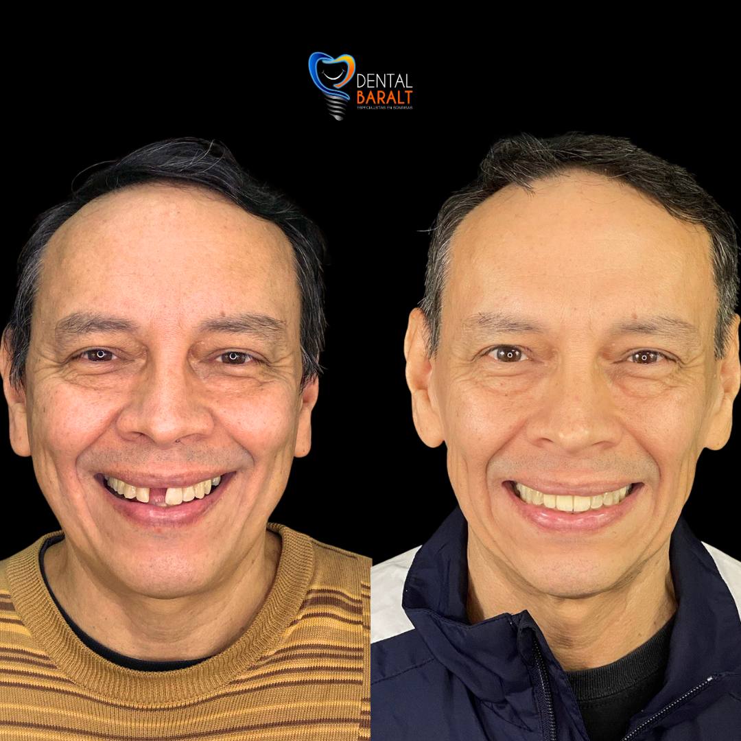 Antes y después coronas dentales