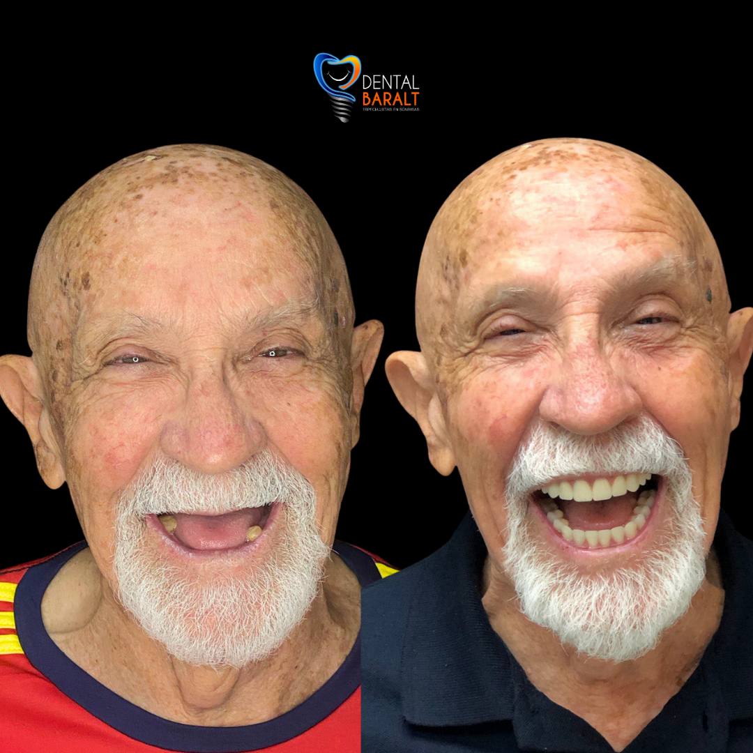 Antes y después coronas dentales