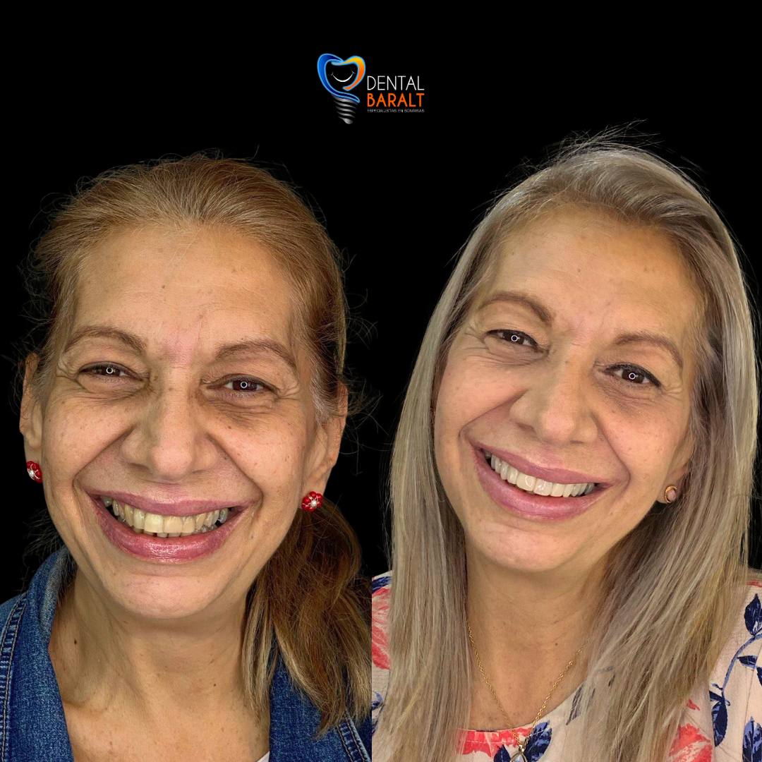 Antes y después coronas dentales