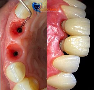 Coronas sobre implantes dentales